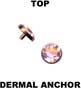 Top for dermal anchor 11026